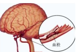 脑动脉硬化症状,常见症状与早期识别